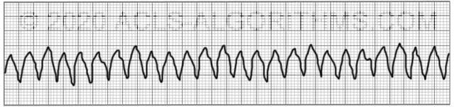 ekg practice worksheets with answers