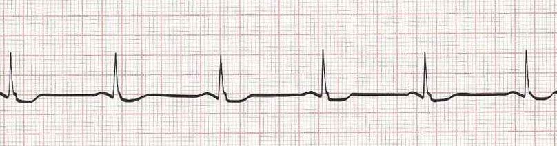 printable heart rhythm strips